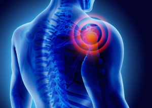Lussazione della spalla: cosa fare in caso di trauma sportivo